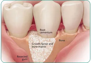 Illustration showing bone grafting procedure for dental implant preparation