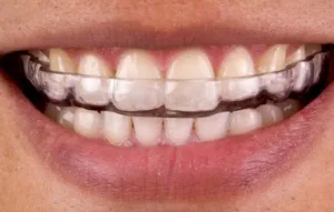 Custom bruxism night guard for teeth grinding treatment at Krutav Patel DDS