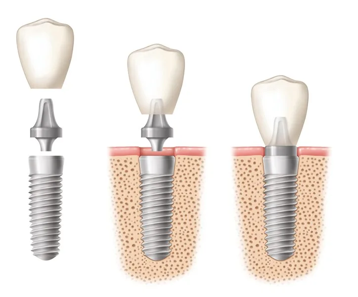Diagram of a dental implant showing crown, abutment, and implant post in the jaw
