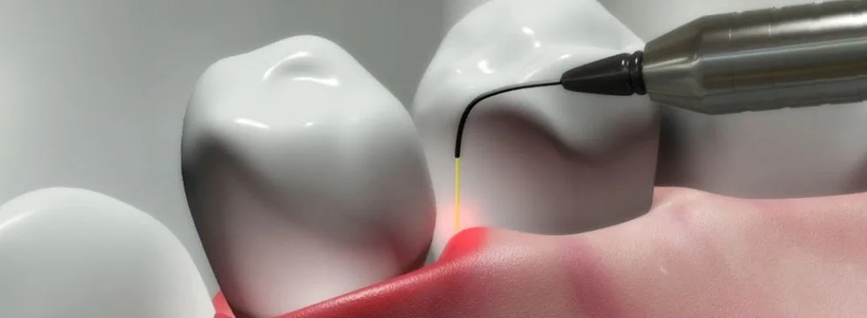 Soft tissue laser being used for gum disease treatment at Krutav Patel DDS