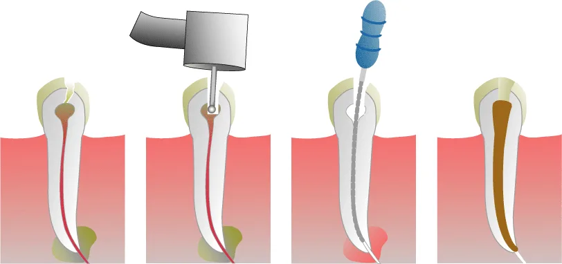 Illustration showing root canal treatment removing infected tooth pulp