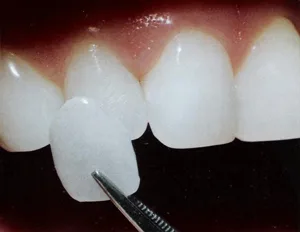 Dental veneer shell shown next to a natural tooth to illustrate the veneer process