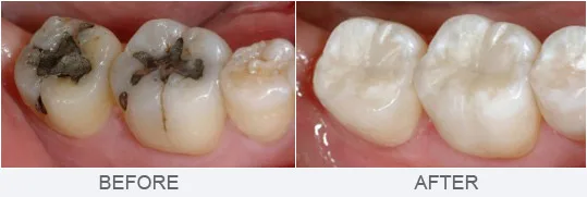 Before and after comparison of tooth-colored composite filling at Krutav Patel DDS
