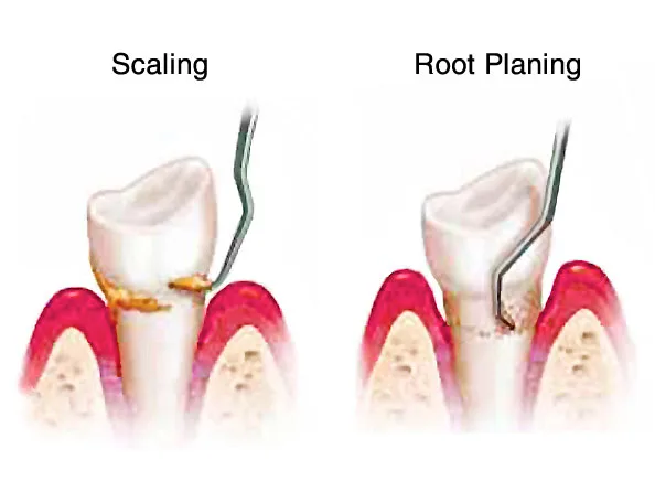 Illustration showing scaling and root planing gum disease treatment
